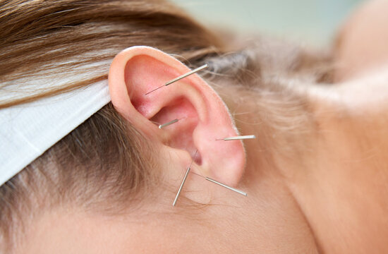Beautiful woman relaxing on a bed having acupuncture treatment with needles in and around her ear. Alternative Therapy concept