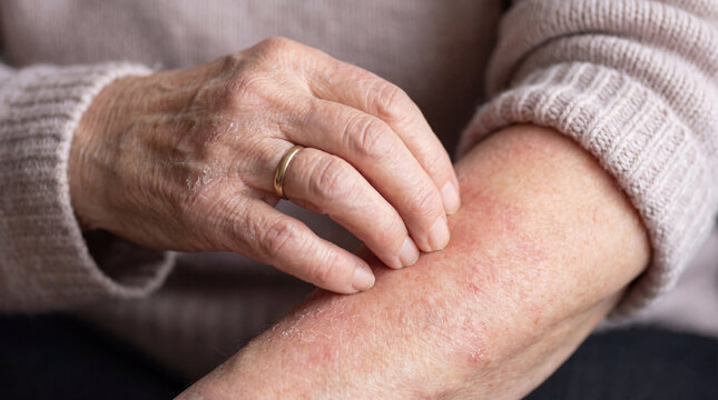 Aged hand, skin rash, itching arm, close up, health care, elder skin