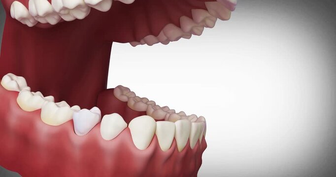 Dental implant 3D animation showing each procedure component implant, abutment and crown separately.