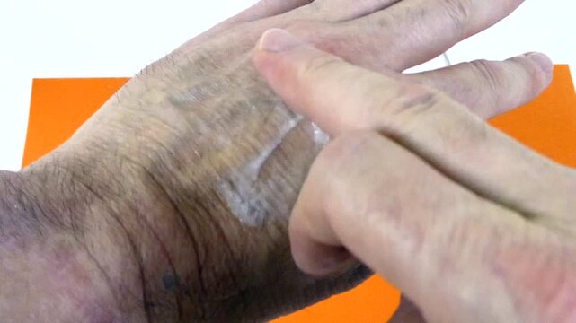 Man putting nourishing lotion on his chapped hands to moisturize and protect the skin
