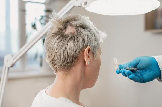 A hand in a medical glove holds a large clump of lost hair against the backdrop of a patient with baldness. A large mole on the patient's scalp. Skin growth removal. Baldness treatment.