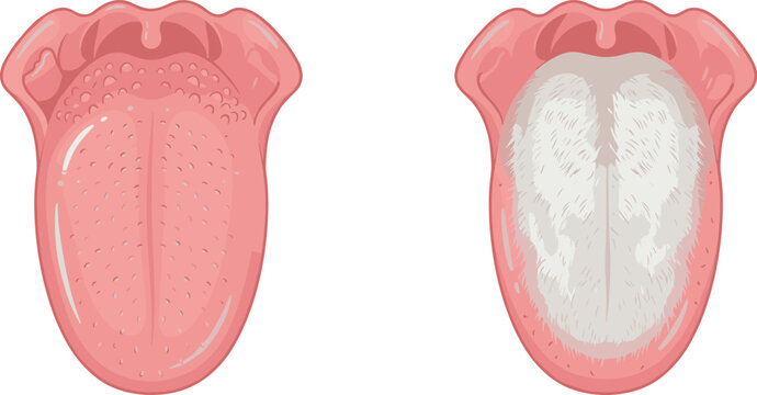 Human Tongue Anatomy Vector Illustration Comparing Normal Pink Surface and Oral Hairy Leukoplakia Medical Condition with Textured White Patches