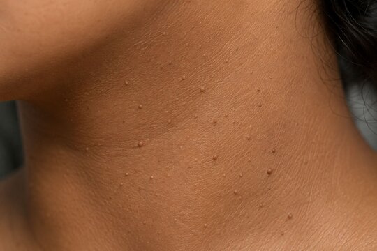 Close Up of Skin Tags on Neck Clinical Dermatology Macro Photography