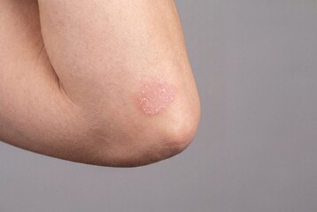 Fototapeta premium Macro shot of a person's elbow showing a dry, flaky, red patch of skin typical of mild psoriasis or eczema.