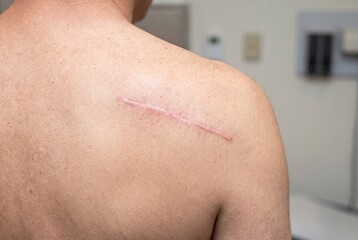 Fototapeta premium Close-up macro shot of a fully healed surgical scar on a person's skin, showing real skin texture and recovery.