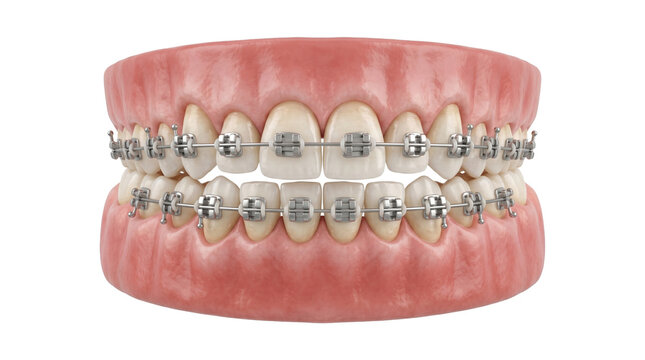 Detailed model of human teeth with braces on both upper and lower jaws isolated on transparent background.