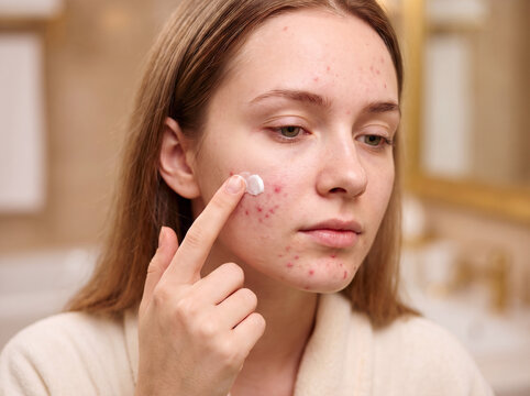 Young woman applying spot treatment cream to her acne prone skin in a bathroom