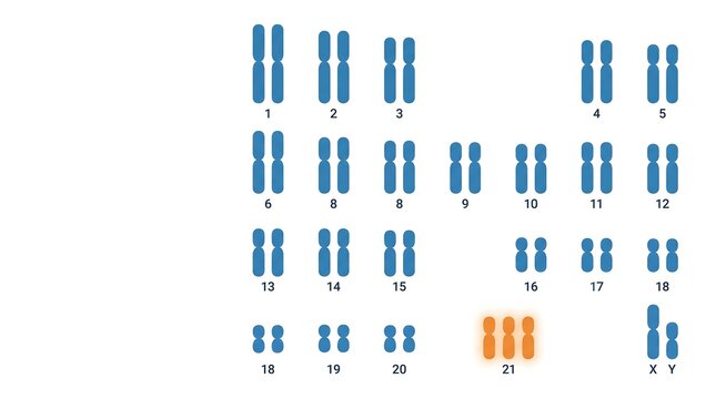 Human karyotype diagram showing Trisomy 21 or Down syndrome genetic disorder.