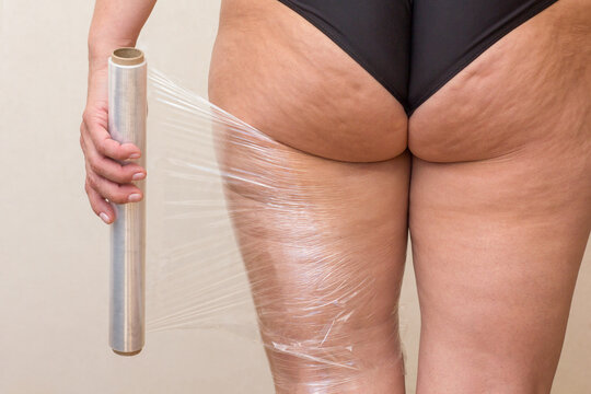 Anti-cellulite wrap in progress: film being applied to the thigh