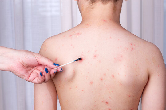 the child is standing with his back, he has a rash on his skin. Chickenpox, it is treated with a solution of brilliant green,