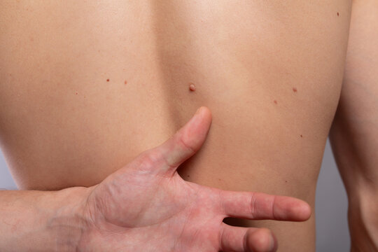 A mole and spots on the young man's back. Concept: regular medical check-ups with a dermatologist or oncologist, spots on a teenager's body