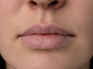 Obraz premium Dry Chapped Lips Close-up