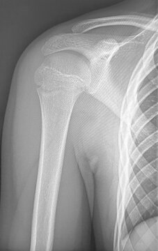 X-ray image of a proximal humerus fracture in the surgical neck of an 11-year-old child, pediatric shoulder radiography showing broken upper arm bone after trauma