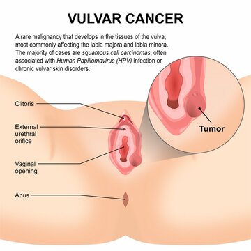 Vulvar Cancer Medical Educational Flashcard
