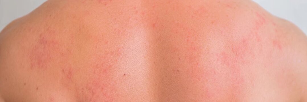Panoramic close up of red irritated rash on human back skin, dermatology, allergy, healthcare, skin condition
