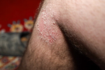 Fototapeta premium A macro shot displays an affected area of dry, peeling skin with redness on a man's leg or knee. The close-up focuses on symptoms of dermatological issues such as psoriasis, eczema, allergic reaction,