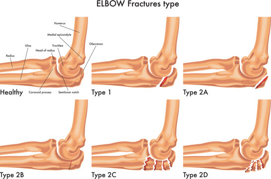 elbow fractures.eps