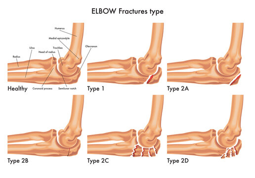 elbow fractures.jpg
