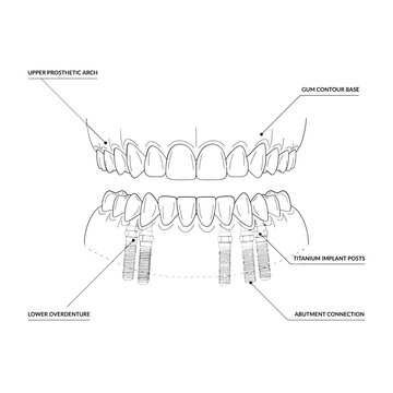 Dental Implant Diagram With Labels Line Illustration On White Background