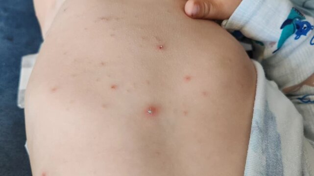 a  varicella skin