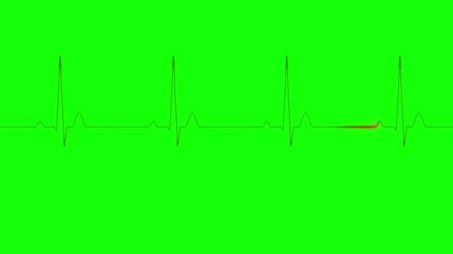 Animated ECG Heartbeat Pulse Line Wave Scrolling Motion on Green Screen with Black Background Chroma Key Overlay for Medical Healthcare Cardiology Hospital Fitness Awareness Broadcast Video Production