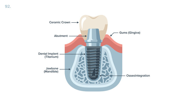 Dental Implant Anatomy: Crown, Abutment, Titanium Fixture, Jawbone, Gingiva