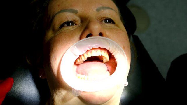 Screw retained implant crown installation with prosthetic screw tightening by dentist in red gloves during modern dental treatment