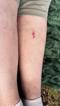 Close-up of a red mosquito or midge bite on a person's lower leg outdoors, details of the insect bite on the skin, showing irritation and a small wound