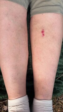 Close-up of a red insect bite on the lower leg, skin irritation, minor injury, health and active leisure