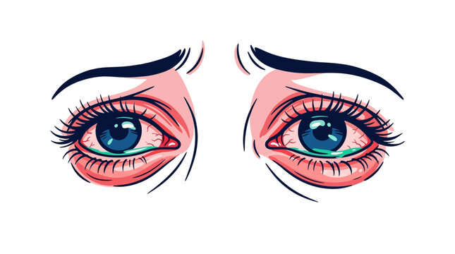 Illustration of Red Bloodshot Irritated Eyes