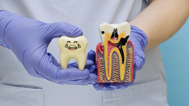 Dentist hands in purple gloves holding a healthy happy tooth toy and a cross-section model of a decayed tooth with caries.