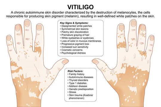 Vitiligo, Skin Disorder, Flashcard Illustration