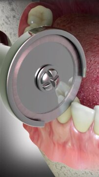 Interproximal Reduction or Stripping- A common orthodontic procedure