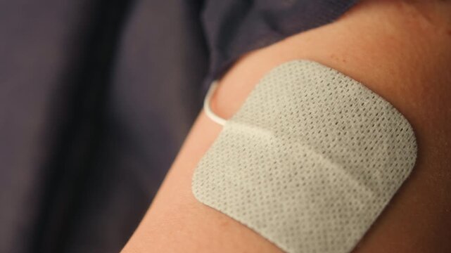 Close-up of electrical muscle stimulation pads attached to upper arm. Electrotherapy, physiotherapy, muscle recovery and rehabilitation concept. High quality 4k footage