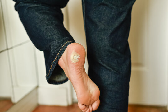 A person in blue jeans stands on one leg, lifting their foot to show a plantar wart on the heel. The close-up view reveals a calloused viral skin lesion.