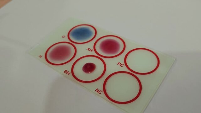 ABO and Rh blood grouping slide agglutination test performed in clinical laboratory. Blood samples mixed with antisera on a blood typing card for determining ABO and Rh (D) blood groups