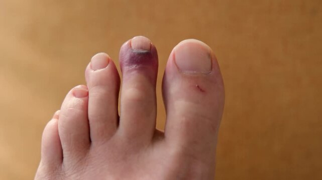 Trending Swollen Bruised Toe Injured Human Foot Trauma Medical Condition in 4K Ultra HD footage.
