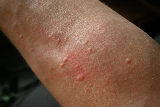Skin Allergy Rash Appears on Arm 