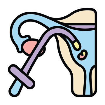 Medical illustration of intrauterine insemination (IUI) or embryo transfer procedure in the female reproductive system.