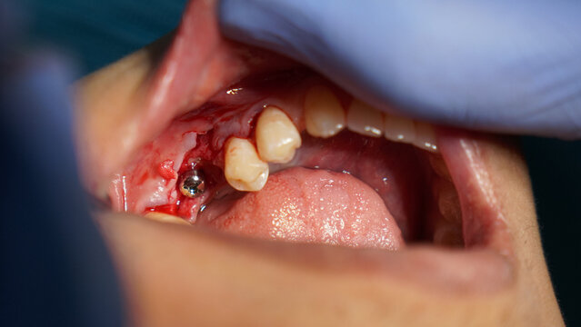 Close Up Of Dental Surgical Procedure Showing Exposed Gum And Missing Tooth
