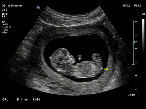 First Trimester Pregnancy Ultrasound Showing Embryo at Eight Weeks