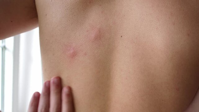 Mosquito bites on unrecognizable caucasian teenage boy back skin rash allergy insect irritation healthcare concept in 4K Ultra HD footage.
