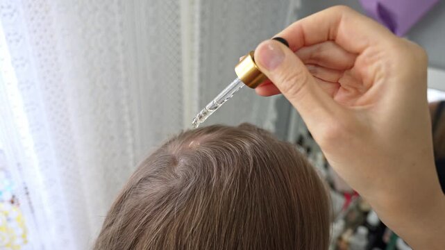 Close-up of a female hand applying a therapeutic hair growth serum with a dropper directly to the scalp, a treatment for alopecia, hair thinning, or baldness to promote follicle stimulation