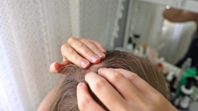 Closeup view of a woman's hands parting her hair to reveal a bald patch on her scalp, a symptom of alopecia areata, demonstrating the effects of hair loss and thinning due to this condition
