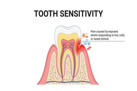 Tooth diagram showing exposed dentin causing pain from heat, cold, or sweets.