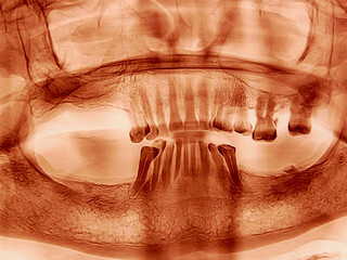 Orthopantomography OPG x-ray. Panoramic Dental X-ray of Human Jaw and Teeth. © Salah Uddin