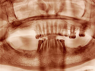 Orthopantomography OPG x-ray. Panoramic Dental X-ray of Human Jaw and Teeth. © Salah Uddin