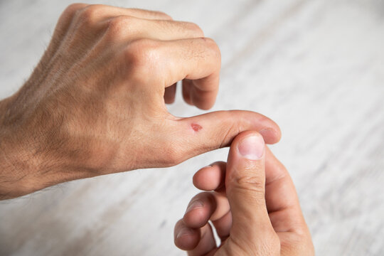 Caucasian man showing callus on hand.