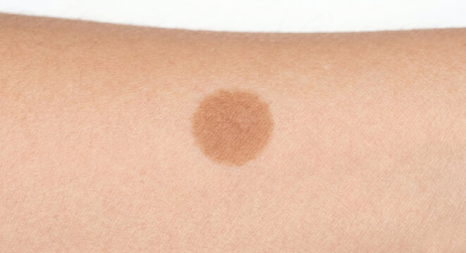 Normal Macule - Well-circumscribed macule on human skin - Macule in Human Skin &mdash; Medical Dermatology Plate (1-100) 