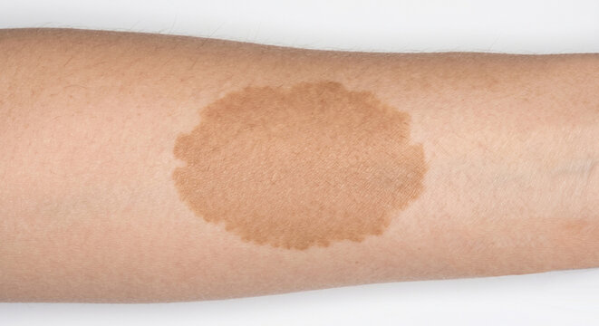 Pigmented birthmarks - Caf&eacute;-au-lait birthmarks - close-up of a single large light brown hyperpigmented macule on human skin, Macule in Human Skin &mdash; Medical Dermatology Plate (6-100) 